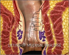 Thd Operation THD & HALO Treatment for Piles & Haemorrhoids | Glasgow Colorectal Centre