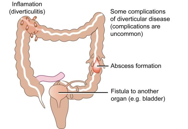 Complications of diverticular disease