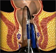 THD proctoscope in anus with about to be passed around the haemorrhoidal artery