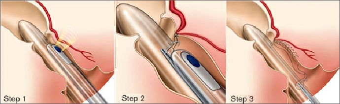 The three steps required when performing a THD procedure for prolapsing haemorrhoids/piles 