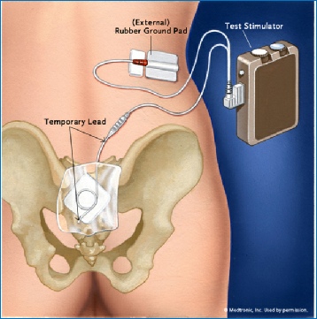 Sacral Nerve Stimulation (SNS) - Bowel / Faecal Incontinence