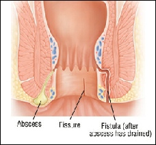 Perianal Abscess Fistula In Ano Causes Treatment Surgery