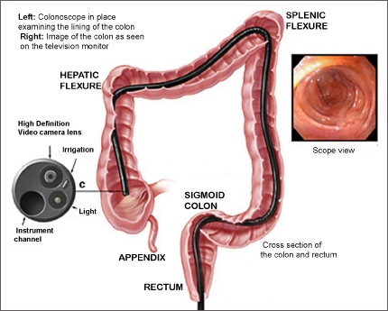 Colon and rectum containing a colonoscope, a view of the end of a colonoscope and a view of the colon during a colonoscopy