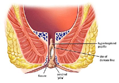 fissure skin