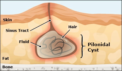 Pilonidal Sinus: Pictures, What is it, Causes, Symptoms