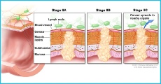 Diagram showing TNM stages of colon cancer