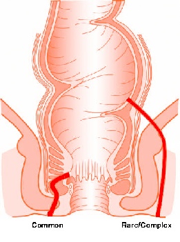 Lump on left side of anus